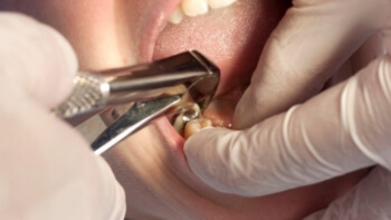 Tooth site on bump extraction Dental Health: