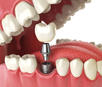 Dental implant animation closeup