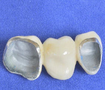 Dental bridge closeup