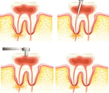 Root canal procedure animation photo