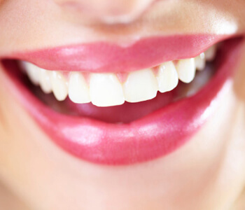 Houston area dentist offers tooth colored fillings