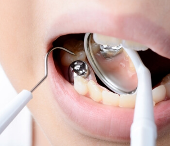 Dentist removing metal filling from tooth