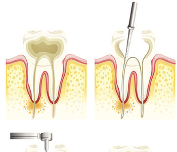 The root canal treatment process
