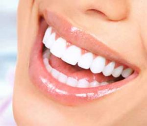 Dental veneers should be brushed and flossed as the natural teeth are, and patients should be diligent about routine dental visits.