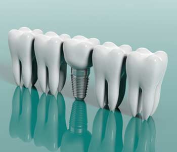 3D Image of a Dental Implant