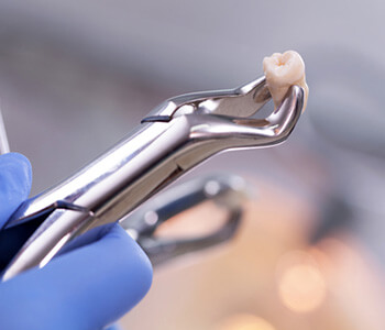 Wisdom Tooth Extraction in Houston TX area