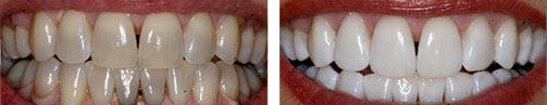 Teeth whitening before after image