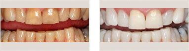 Teeth Whitening Before and after 01
