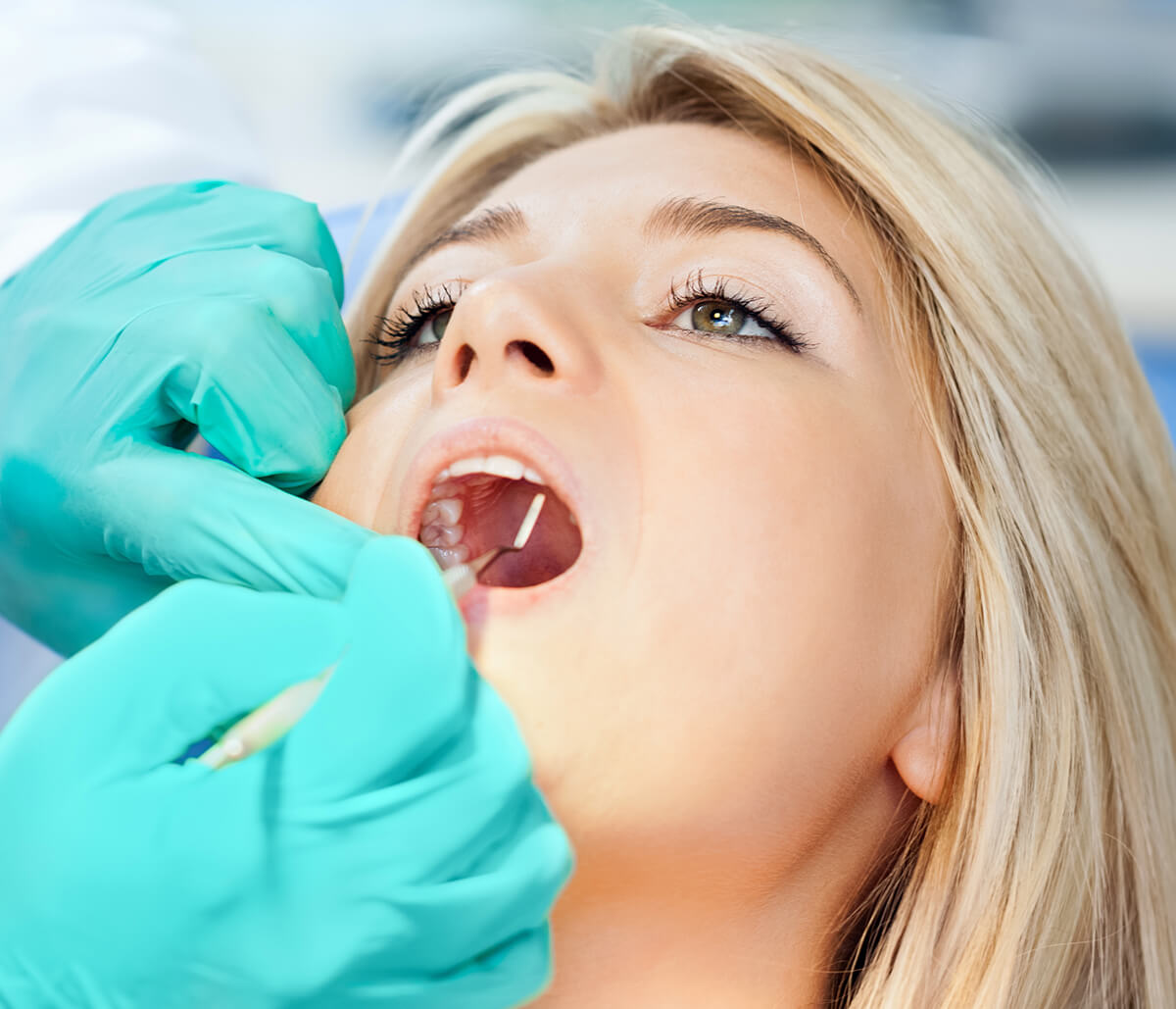 Root Canal Treatment Process in Houston Area