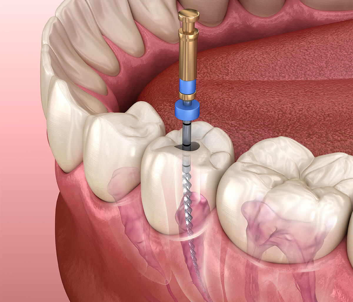 Infected Root Canal Treatment in Houston TX Area