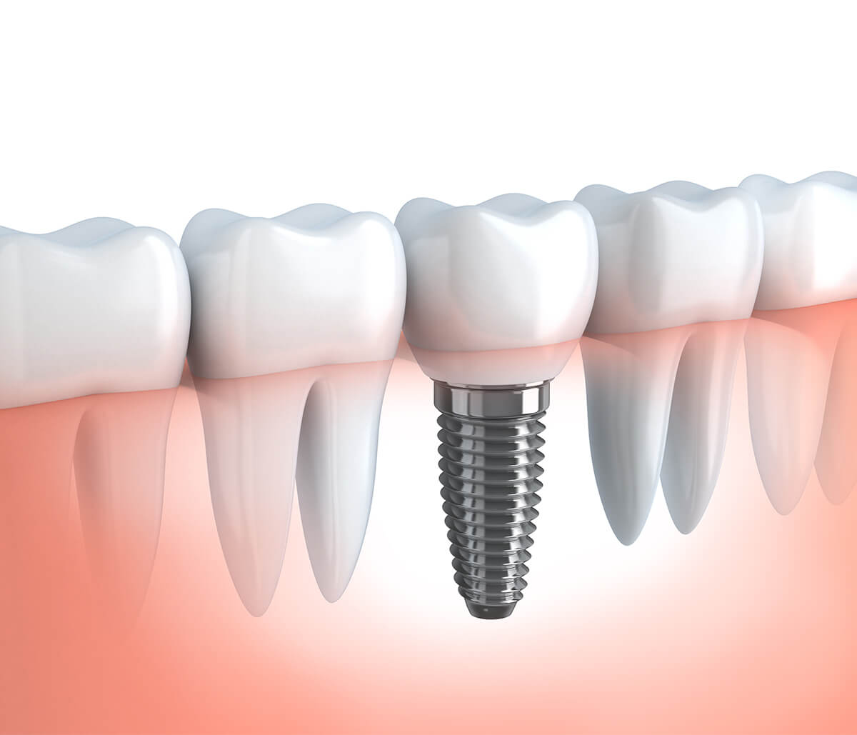 Dental Implant Care After Surgery in Houston TX Area