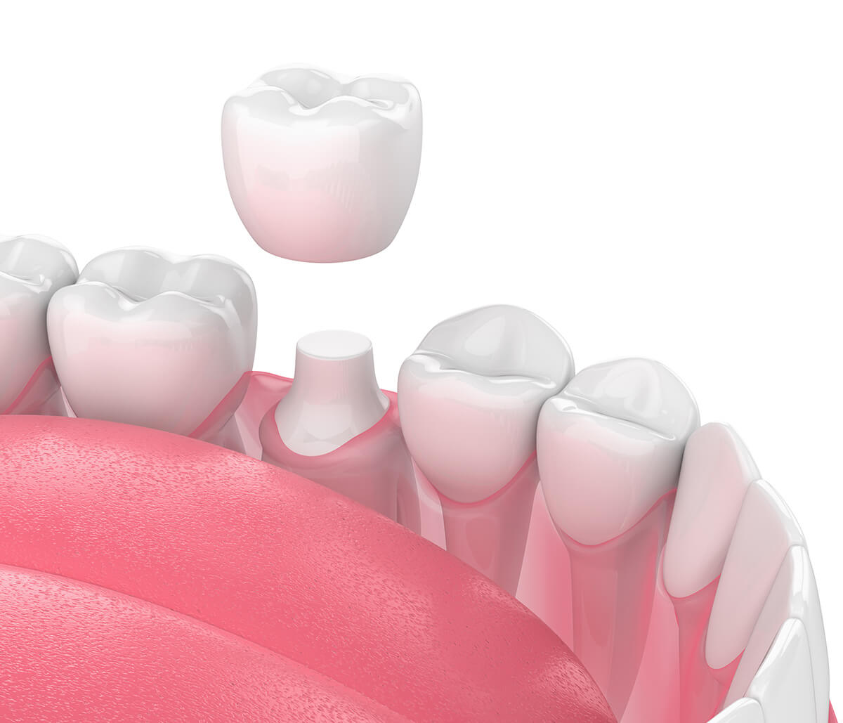 Crown Tooth Replacement in Houston TX Area