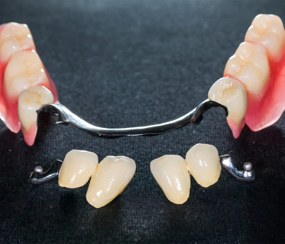 Removable Partial Denture in Houston TX Area