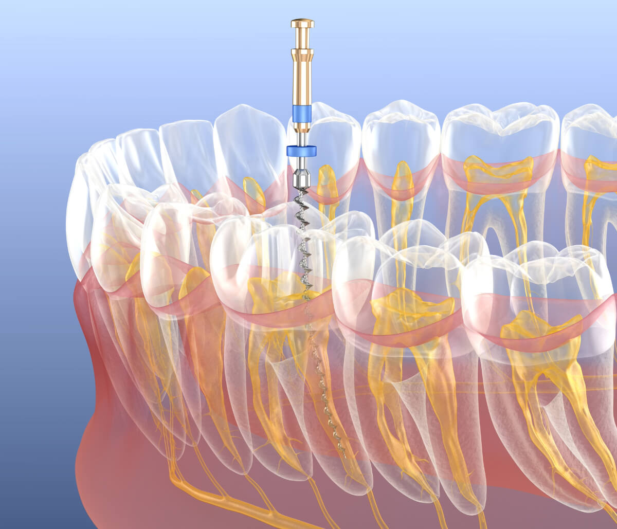 Root Canal in Houston TX area